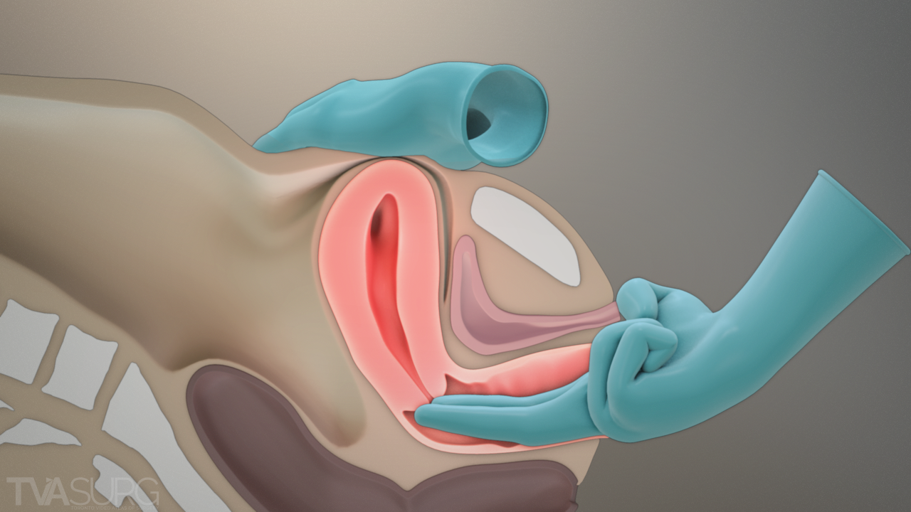 Can Cervical Checks Induce Labor at 37 Weeks?